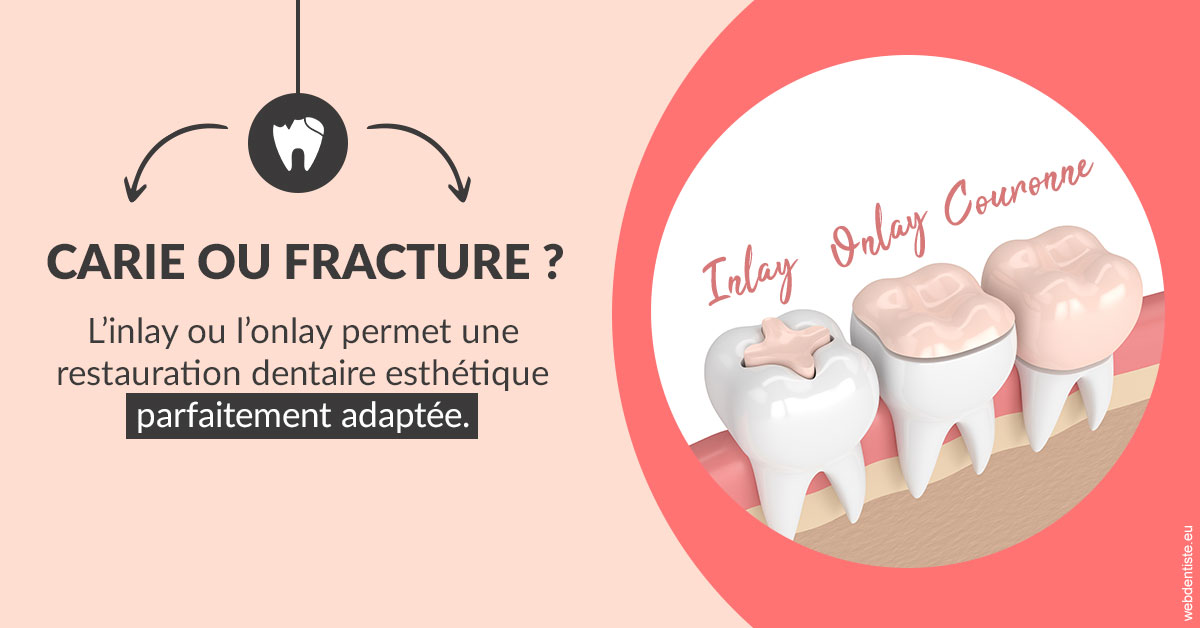 https://dr-dehay-dorothee.chirurgiens-dentistes.fr/T2 2023 - Carie ou fracture 2