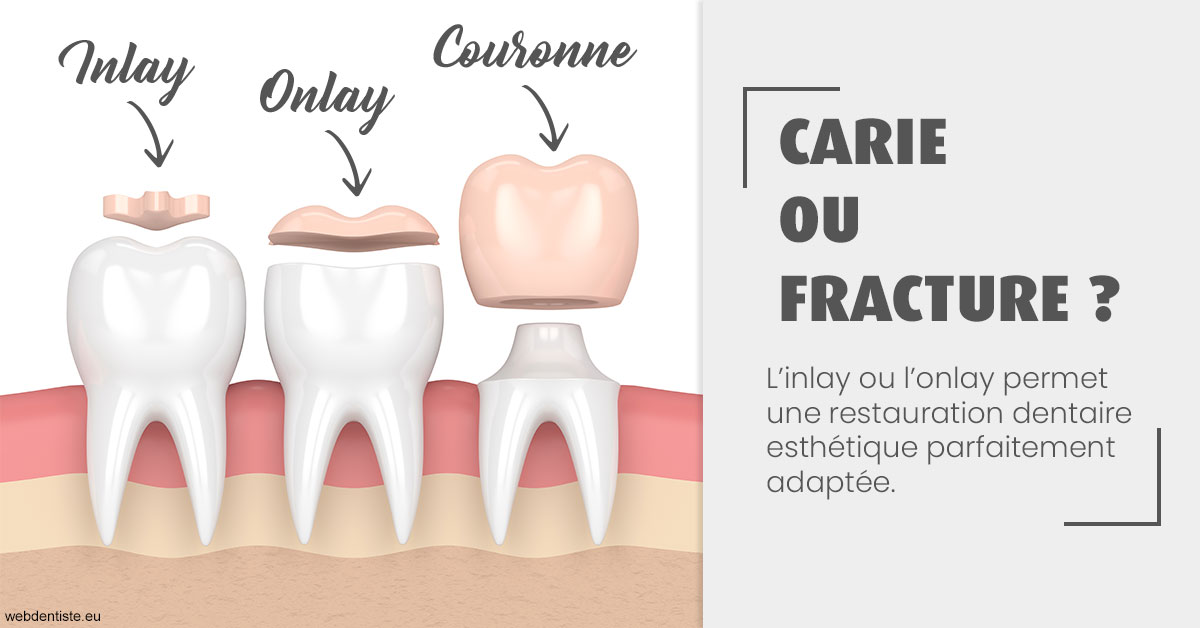 https://dr-dehay-dorothee.chirurgiens-dentistes.fr/T2 2023 - Carie ou fracture 1