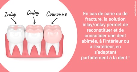 https://dr-dehay-dorothee.chirurgiens-dentistes.fr/L'INLAY ou l'ONLAY 2